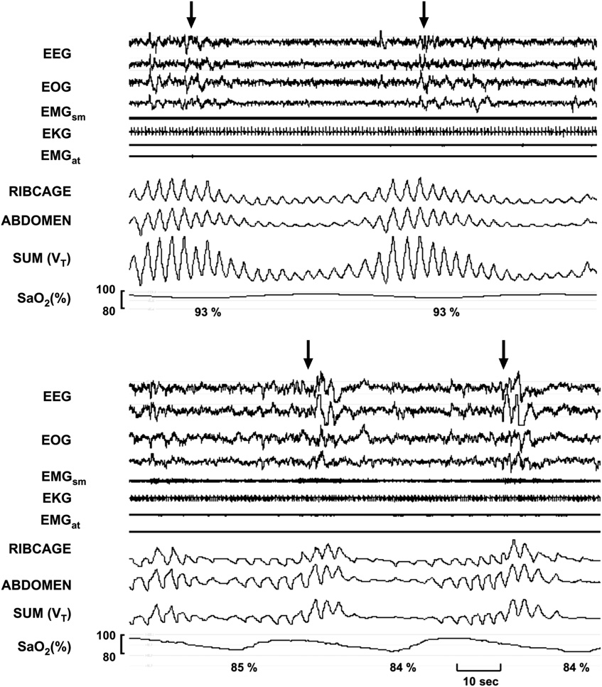Polysomnographic recordings of CSR-CSA